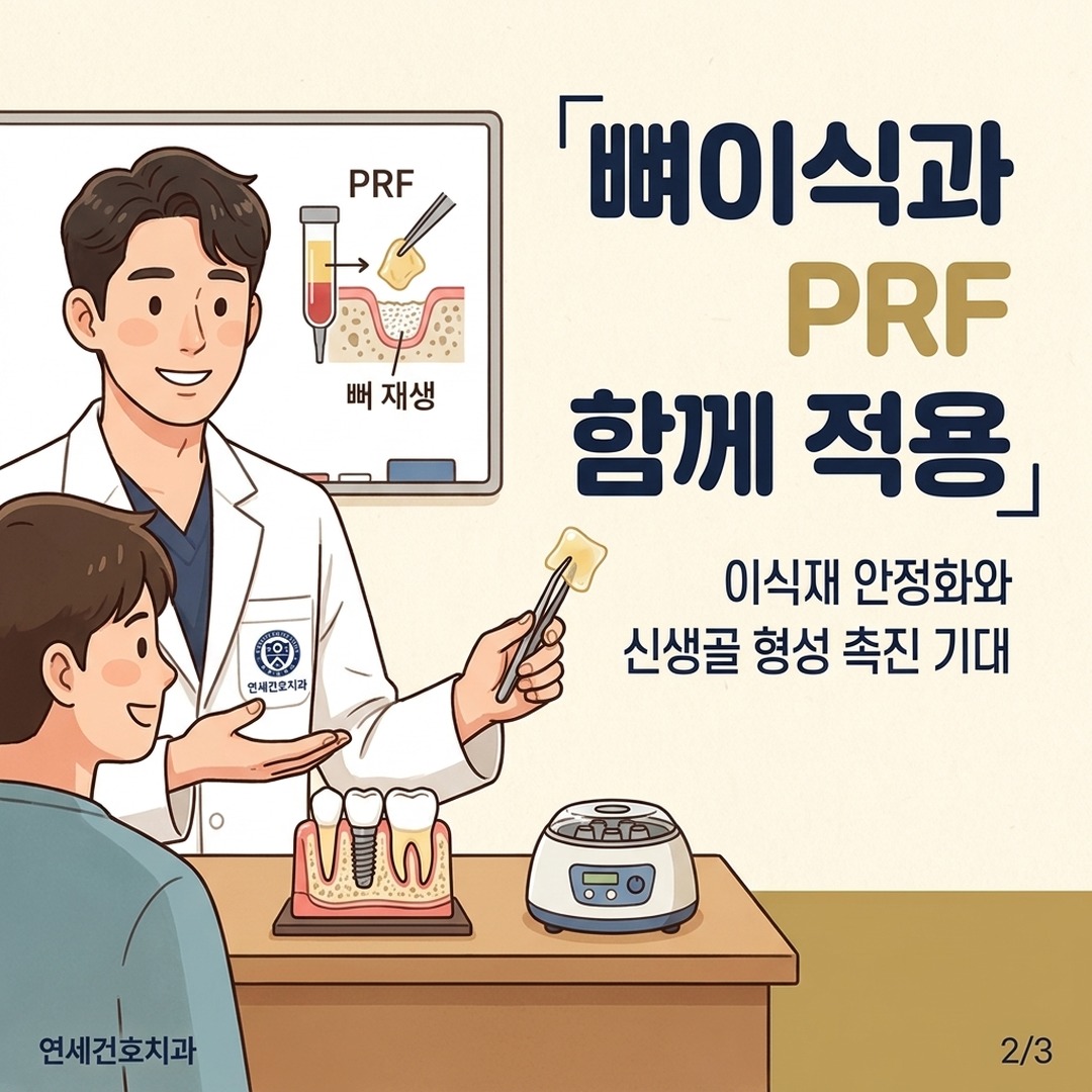 PRF 막을 뼈이식재와 함께 적용하는 임플란트 시술 설명